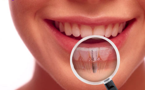 dental-implants-costa-rica-treatment.jpg