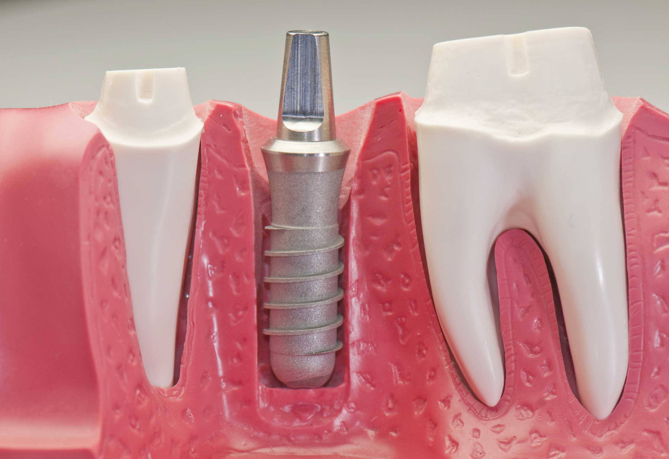 dental-implants-dentist-anchorage-ak.jpg