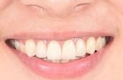 成人矯正治療後齒列與笑容